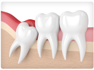 Leia mais sobre o artigo Remoção dos dentes do siso: o que esperar