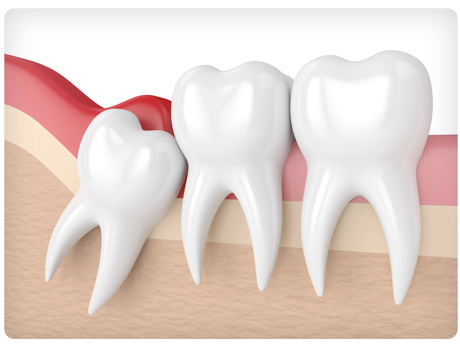 Você está visualizando atualmente Remoção dos dentes do siso: o que esperar
